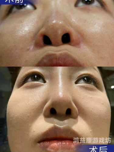 抗癌后女子用腹部赘肉再造乳房，重获新生的勇气与智慧