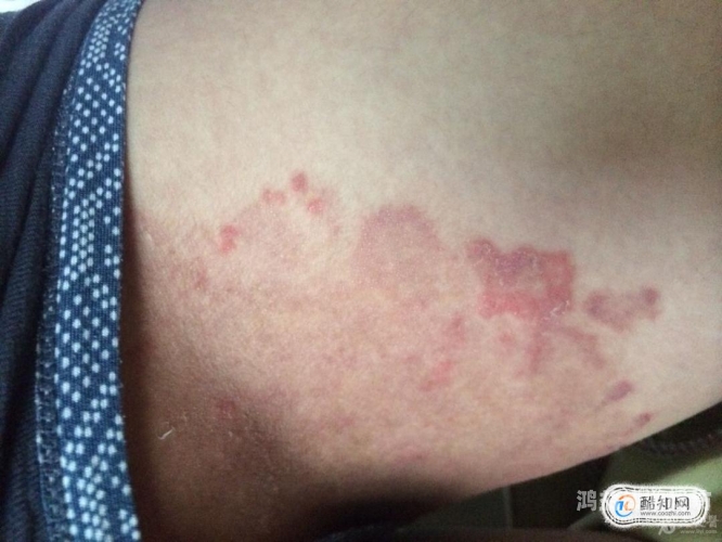 如何判断是股癣还是阴囊湿疹？两者有相似之处，但也有独特的特征怎么判断是股癣还是阴癣