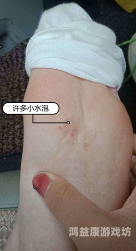 脚底长水泡样异物，奇痒难忍？可能是这些原因导致的儿童脚底长了像水泡一样的东西很痒