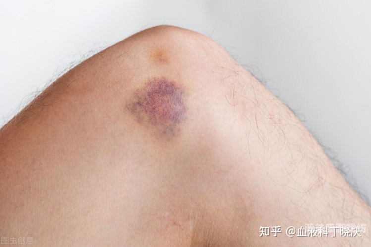 血小板减少性紫癜能根治吗？